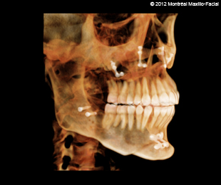 Marie-Hélène Cyr - 3D scan (45 degrees right profile) after orthodontic treatments and orthognathic surgeries (February 13, 2012)